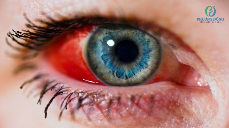Vỡ nhãn cầu là chấn thương Nhãn khoa nguy hiểm cần được cấp cứu y tế khẩn cấp