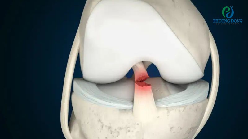 Đứt dây chằng chéo có thể đi lại bình thường nếu được điều trị kịp thời và chăm sóc đúng cách
