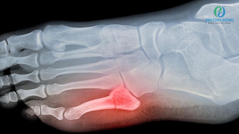 Điều trị rạn xương bàn chân cần được theo dõi sát sao qua hình ảnh X-quang cùng triệu chứng kèm theo