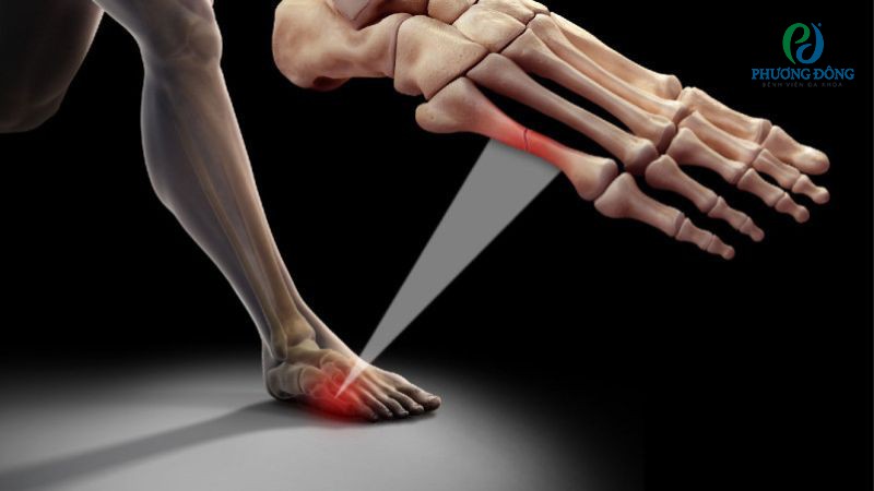 Tư vấn điều trị rạn xương bàn chân tại Bệnh viện Đa khoa Phương Đông