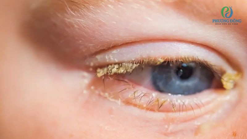 Hỏi đáp chuyên khoa Mắt: Bệnh lậu có lây qua kết mạc mắt không?