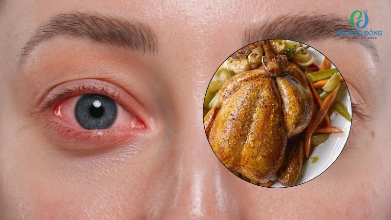 Hỏi đáp bác sĩ Nhãn khoa: Bị viêm kết mạc có được ăn gà không?