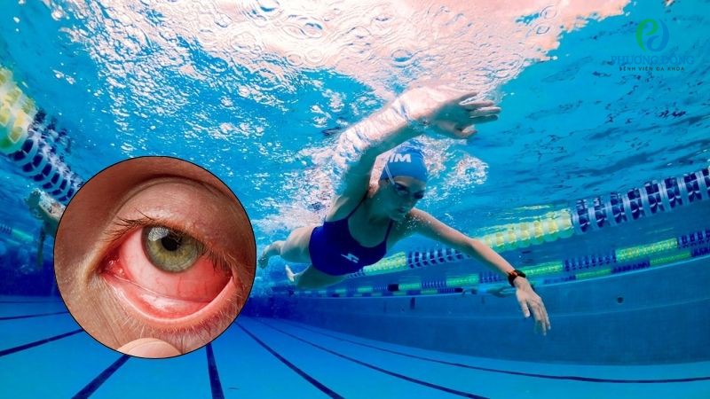 Bác sĩ chuyên khoa Mắt trả lời: Bị viêm kết mạc có được đi bơi không?