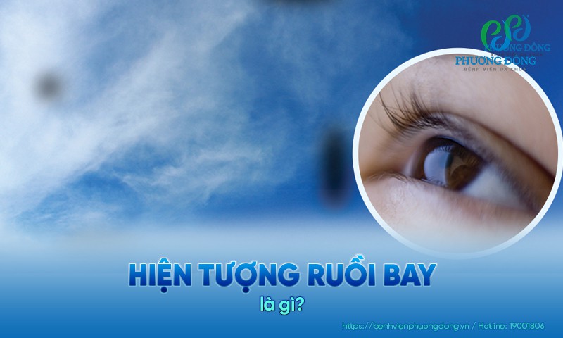 Hiện tượng ruồi bay: Nguyên nhân, điều trị và phương pháp chăm sóc