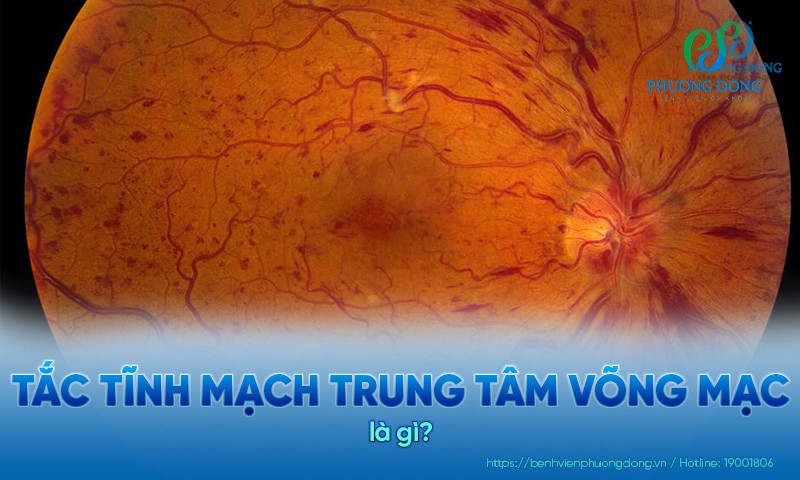 Tắc tĩnh mạch trung tâm võng mạc thường ảnh hưởng ở người trên 50 tuổi