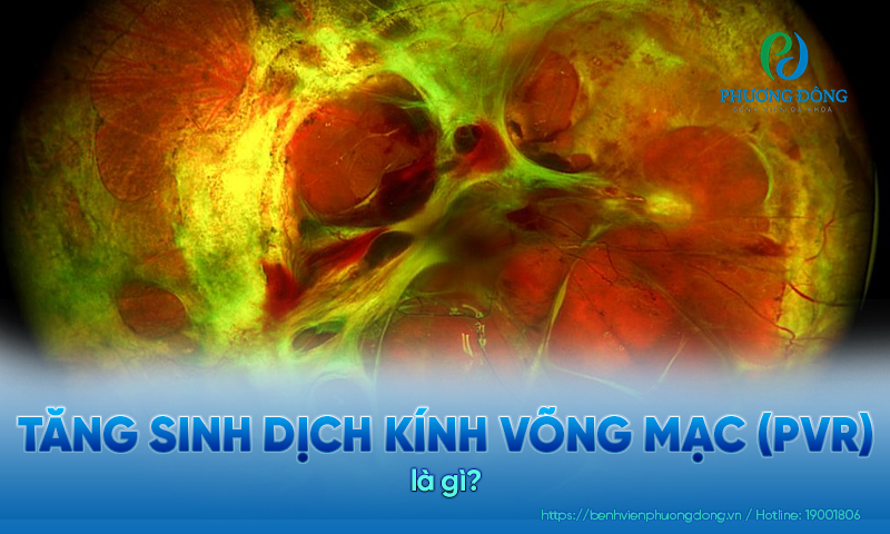 Tăng sinh dịch kính võng mạc (PVR): Phân loại, nguyên nhân và điều trị