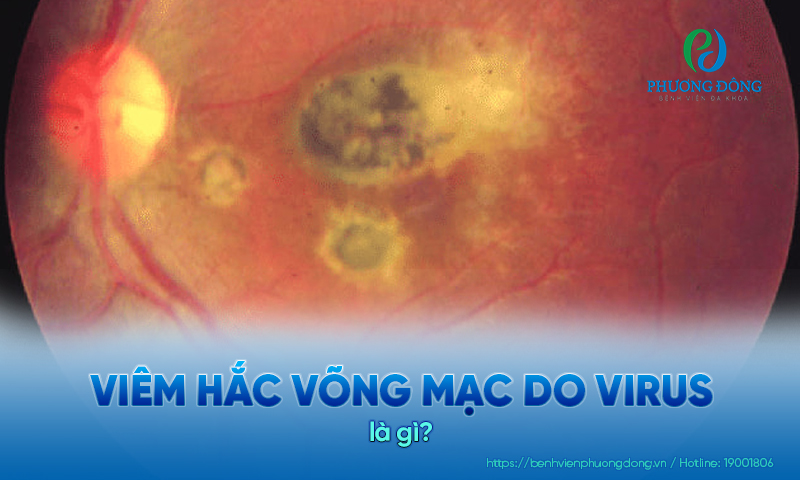 Viêm hắc võng mạc do virus: Dấu hiệu, chẩn đoán và điều trị