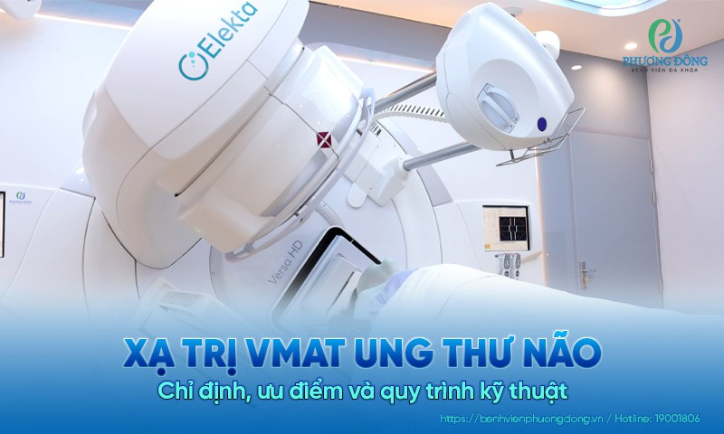Xạ trị VMAT ung thư não: Chỉ định, ưu điểm và quy trình kỹ thuật