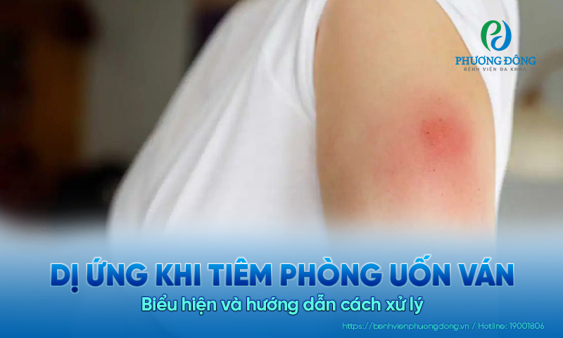 Dị ứng khi tiêm phòng uốn ván: Biểu hiện và hướng dẫn cách xử lý  