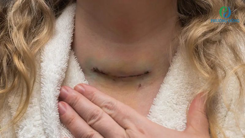 Một số biến chứng có thể gặp phải sau khi phẫu thuật basedow