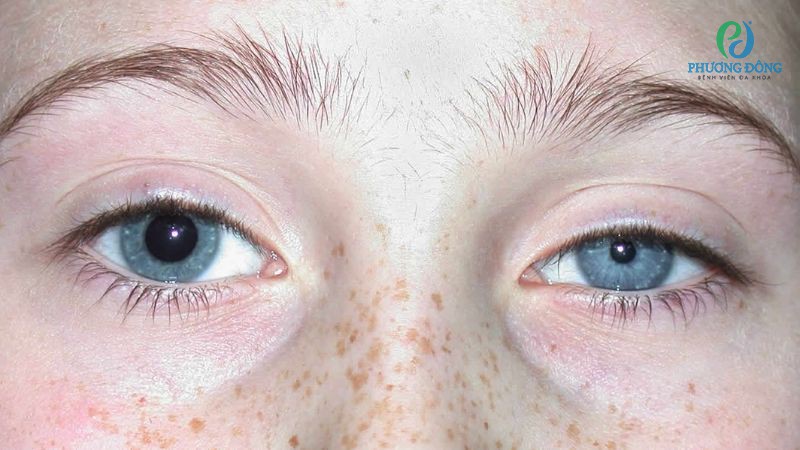 Một số rối loạn về kích thước và chức năng phản ứng ảnh hưởng đến hoạt động của con ngươi