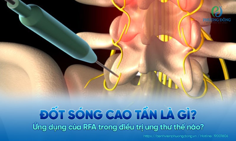 Đốt sóng cao tần là gì? Ứng dụng của RFA trong điều trị ung thư thế nào?