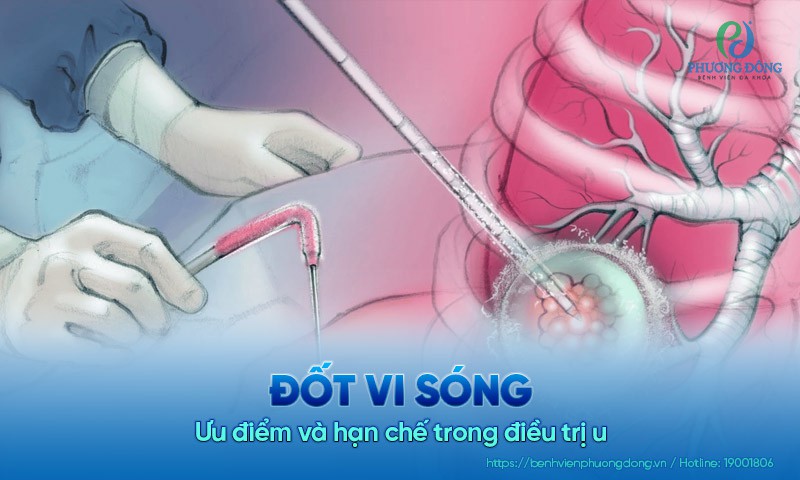 Đốt vi sóng: Ưu điểm và hạn chế trong điều trị u