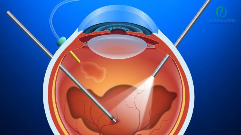 Phẫu thuật cắt dịch kính điều trị hiện tượng ruồi bay