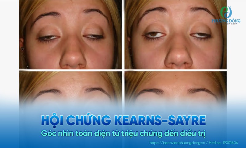 Hội chứng Kearns-Sayre: Góc nhìn toàn diện từ triệu chứng đến điều trị