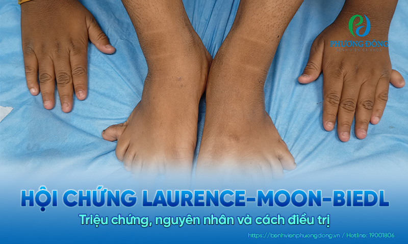Hội chứng Laurence-Moon-Biedl: Triệu chứng, nguyên nhân và cách điều trị 