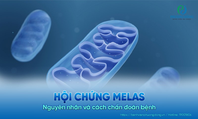 Hội chứng MELAS là gì? Nguyên nhân và cách chẩn đoán bệnh