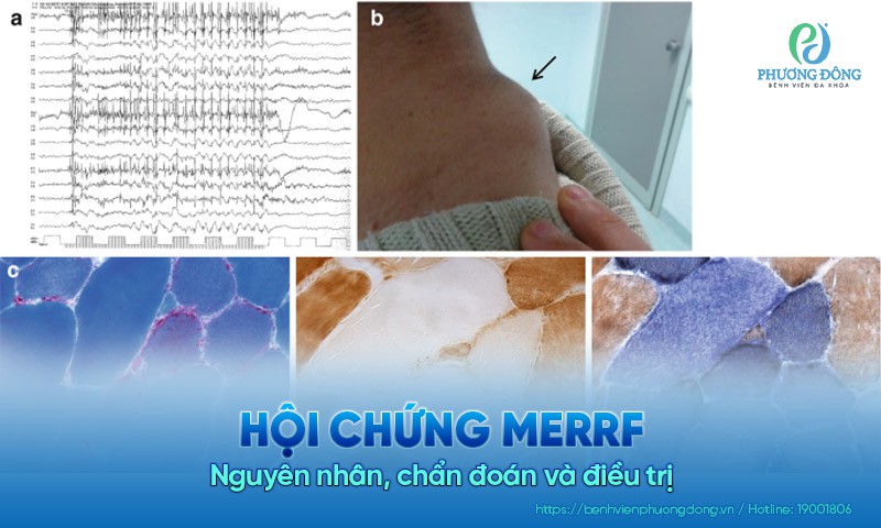 Hội chứng MERRF: Nguyên nhân, chẩn đoán và điều trị