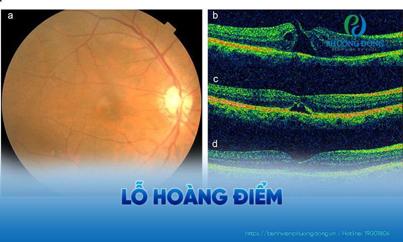 Lỗ hoàng điểm và 6 triệu chứng cảnh báo bệnh lý sớm!