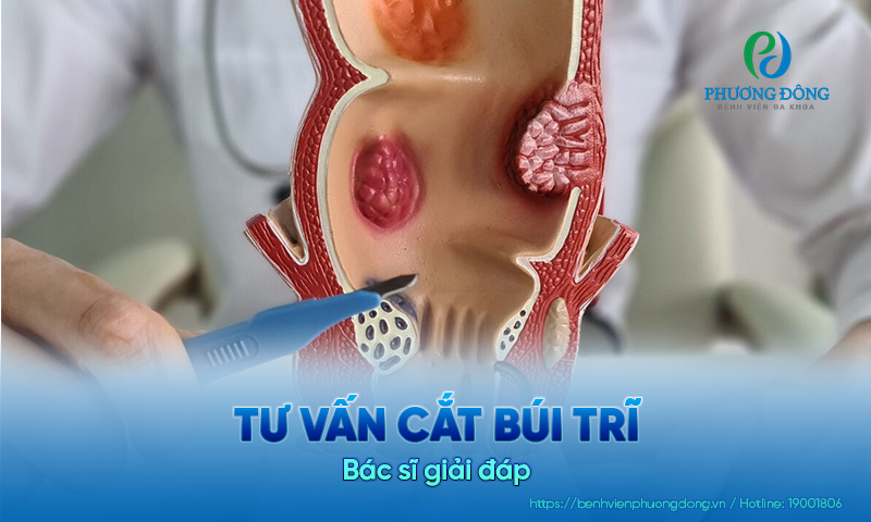 Tư vấn cắt búi trĩ: Bác sĩ giải đáp