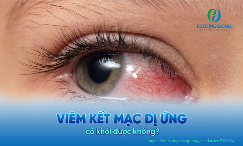 Hỏi đáp bác sĩ Nhãn khoa: Viêm kết mạc dị ứng có khỏi được không?