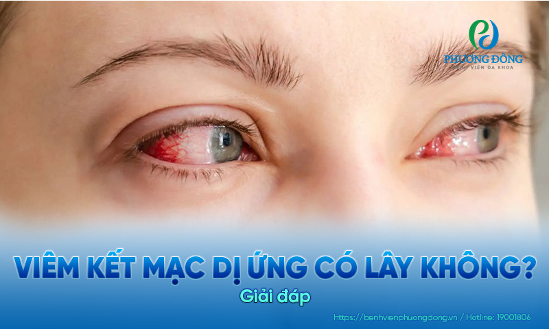 Giải đáp: Viêm kết mạc dị ứng có lây không? 