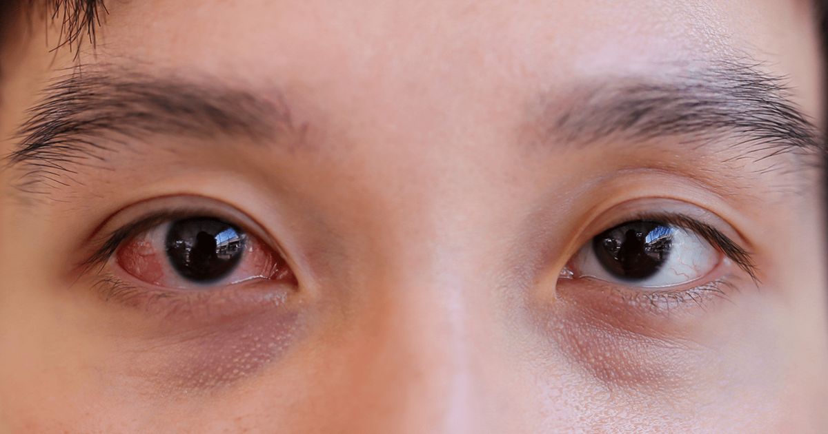 Với các ca đau mắt đỏ mức độ nhẹ, bệnh có thể tự thuyên giảm sau 7 - 10 ngày 