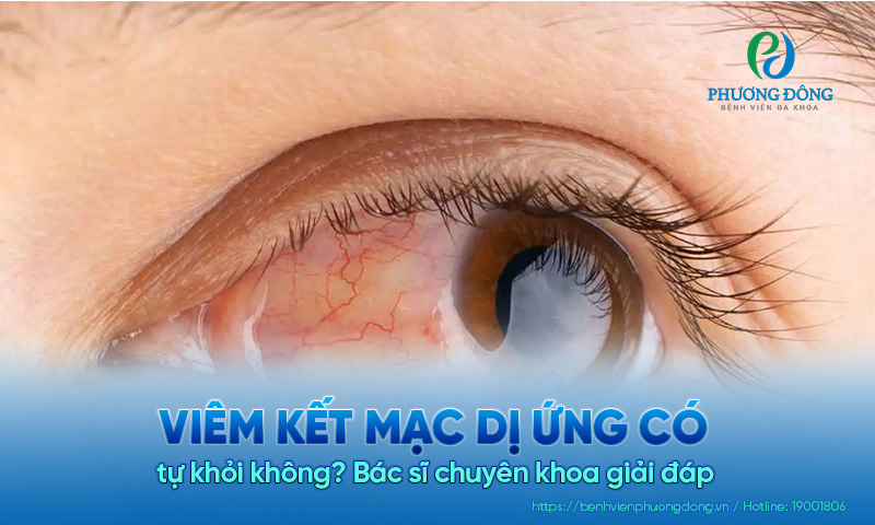 Viêm kết mạc dị ứng có tự khỏi không? Bác sĩ chuyên khoa giải đáp 