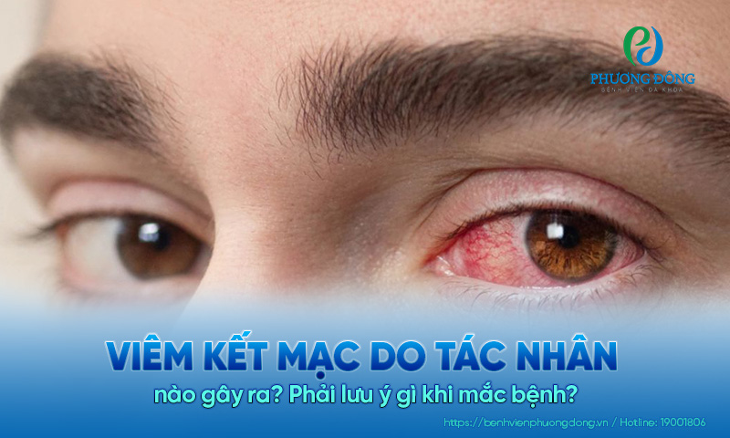 Viêm kết mạc do tác nhân nào gây ra? Phải lưu ý gì khi mắc bệnh?