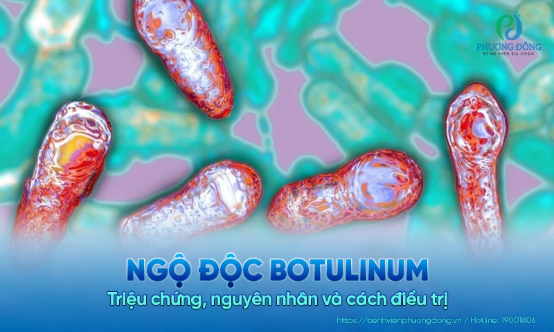Ngộ độc Botulinum: Triệu chứng, nguyên nhân và cách điều trị
