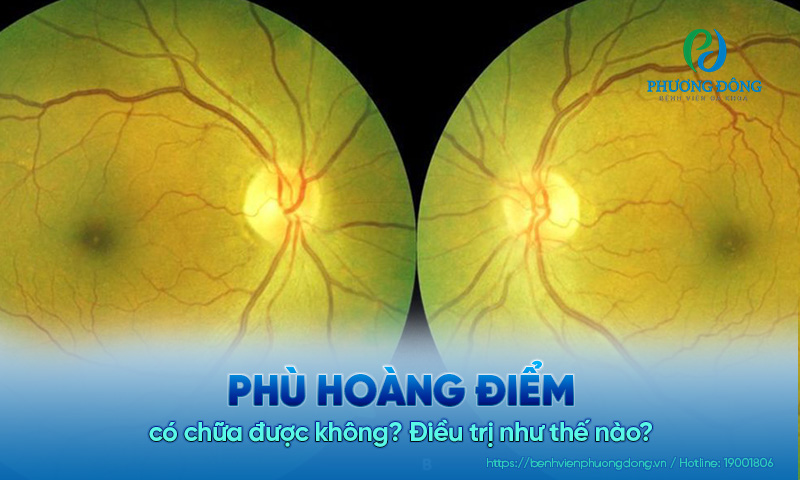 Phù hoàng điểm có chữa được không? Điều trị như thế nào? 