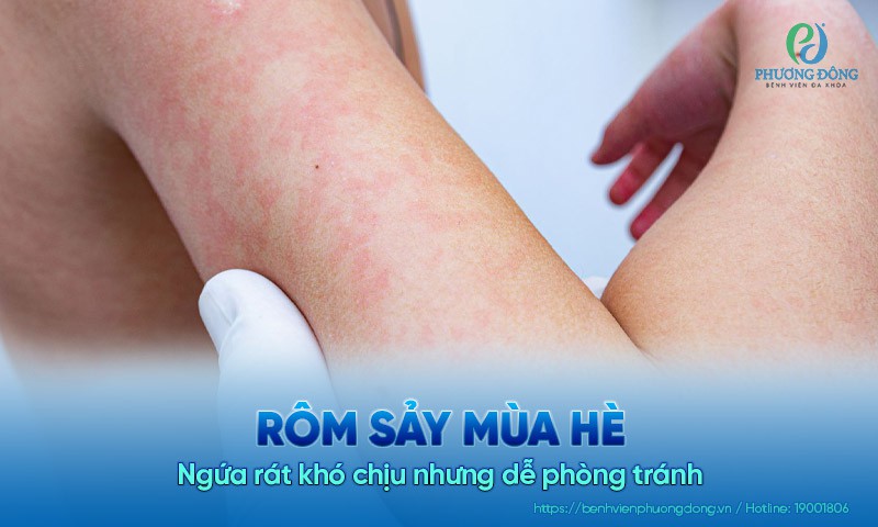 Rôm sảy mùa hè - Ngứa rát khó chịu nhưng dễ phòng tránh