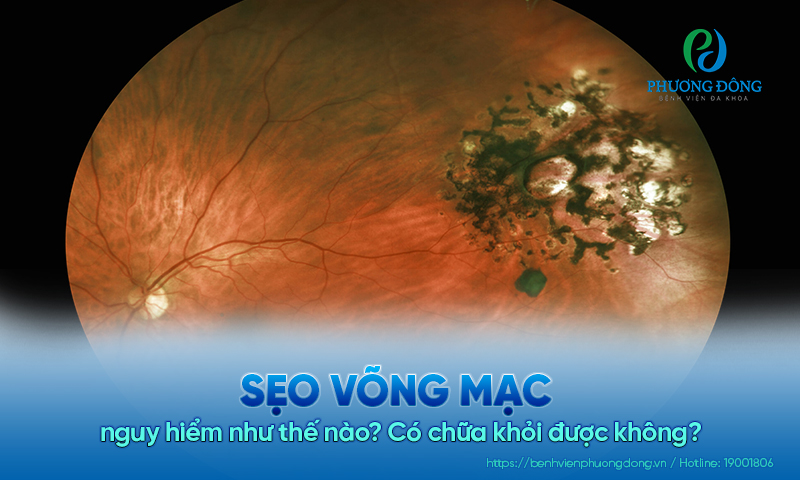 Sẹo võng mạc nguy hiểm như thế nào? Có chữa khỏi được không?