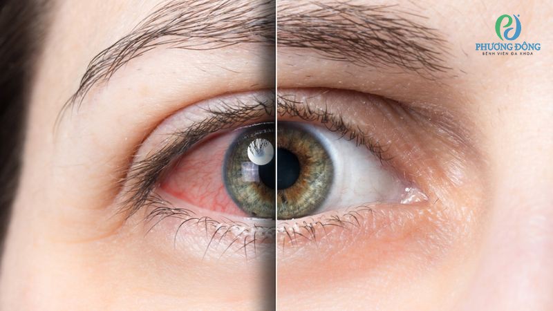 Dấu hiệu nhận biết tĩnh mạch trung tâm võng mạc bị tắc nghẽn