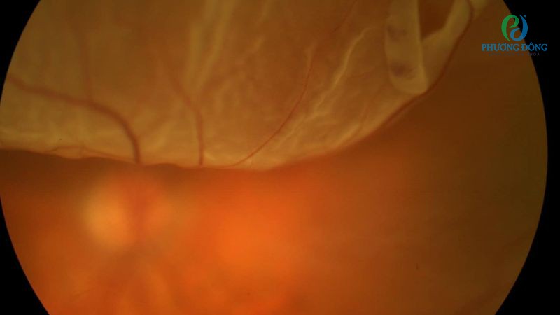 Bong võng mạc là nguyên nhân chính dẫn đến tăng sinh dịch kính võng mạc