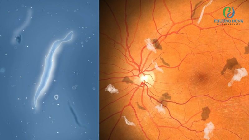 Tăng sinh võng mạc thường dẫn đến hiện tượng ruồi bay trước mắt