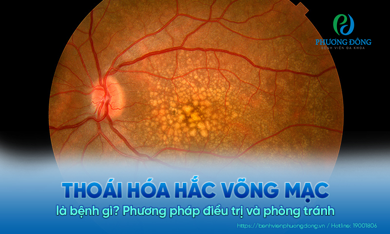 Thoái hóa hắc võng mạc là bệnh gì? Phương pháp điều trị và phòng tránh  
