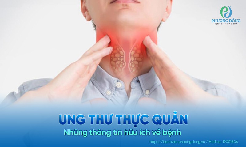Tìm hiểu về bệnh ung thư thực quản - Giải đáp câu hỏi thường gặp