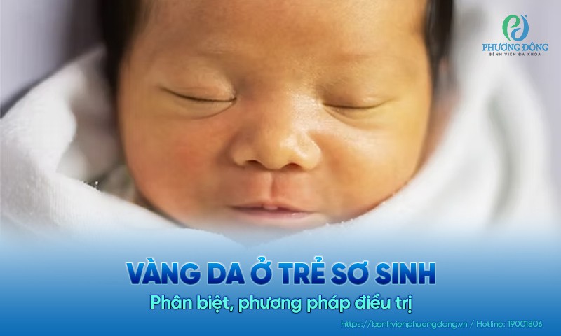 Vàng da ở trẻ sơ sinh