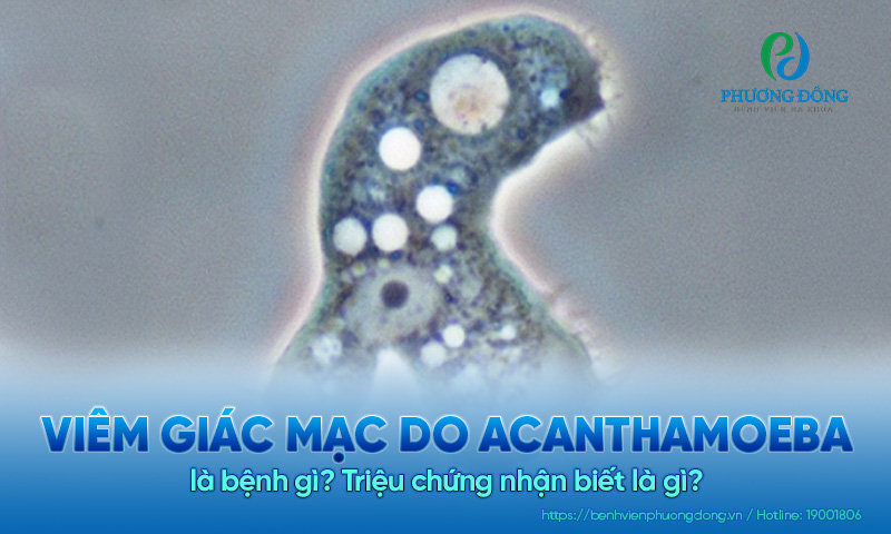 Viêm giác mạc do Acanthamoeba là bệnh gì? Triệu chứng nhận biết là gì?