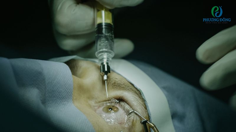 Điều trị viêm hắc võng mạc theo nhóm tác nhân gây nhiễm trùng