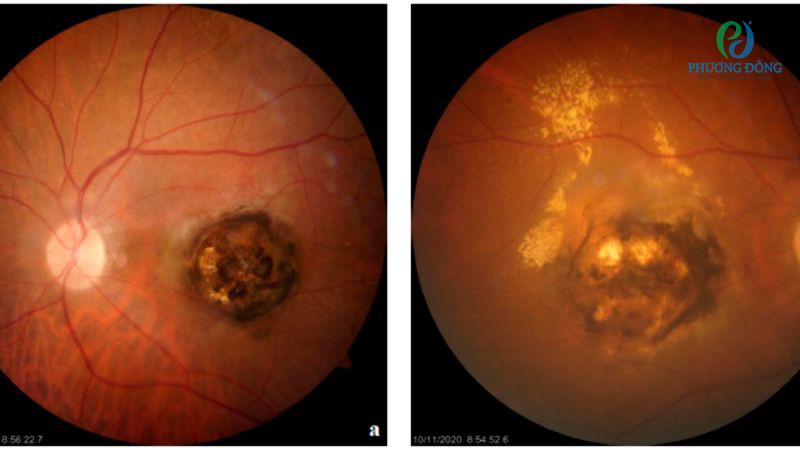 Viêm hắc võng mạc do virus toxoplasmosis có tỷ lệ tái phát cao nhất