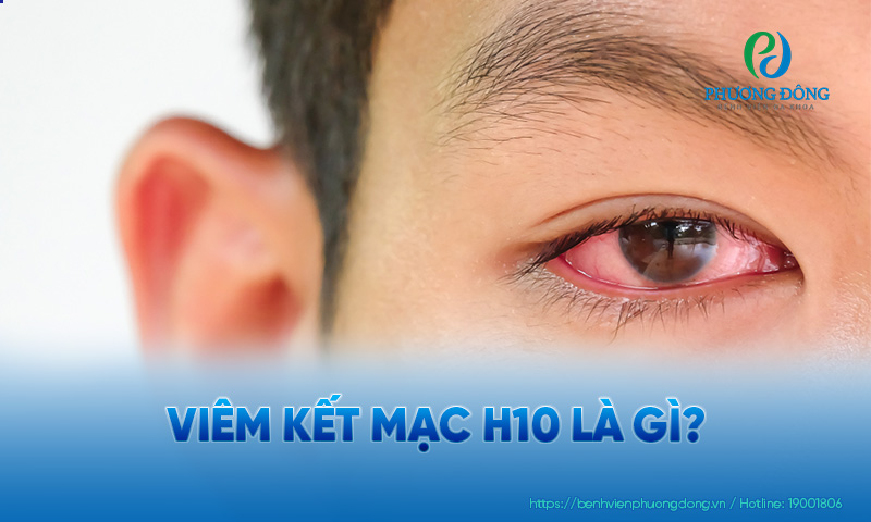 Viêm kết mạc H10 là thuật ngữ chỉ bệnh lý viêm kết mạc nói chung