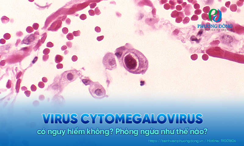 Virus cytomegalovirus có nguy hiểm không? Phòng ngừa như thế nào?