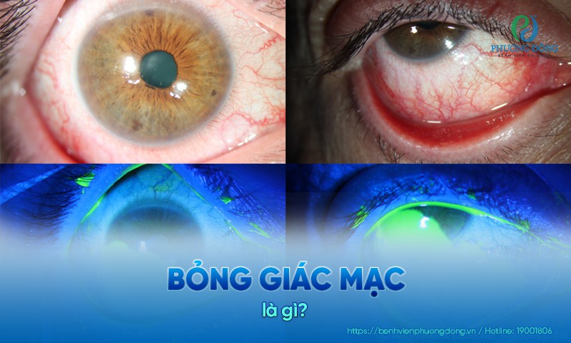 Bỏng giác mạc: Nguyên nhân, biến chứng và điều trị