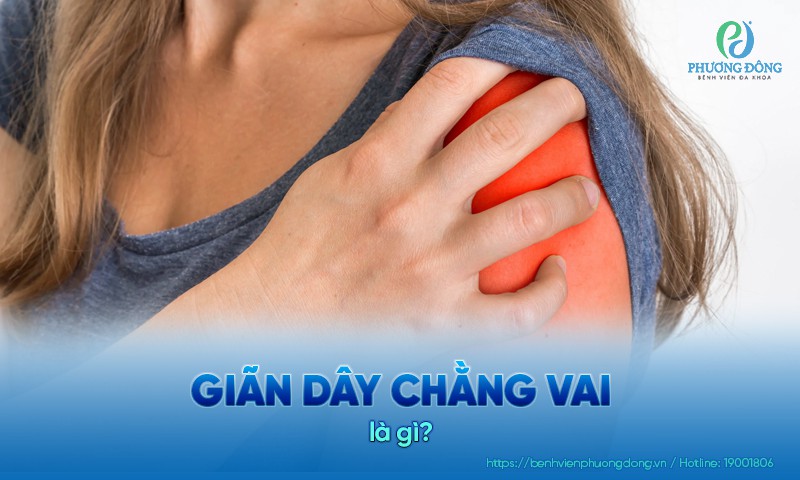 Giãn dây chằng vai: Triệu chứng, nguyên nhân và hướng điều trị