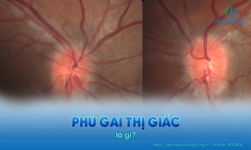 Phù gai thị giác: Nguyên nhân, triệu chứng và điều trị