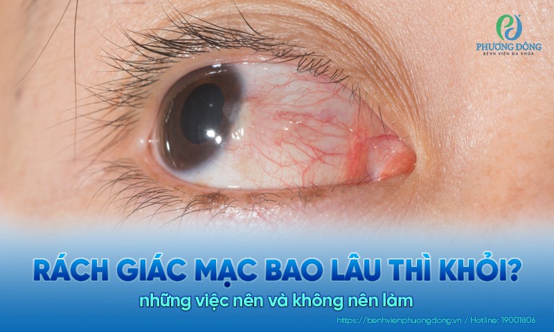Rách giác mạc bao lâu thì khỏi? Những việc nên và không nên làm