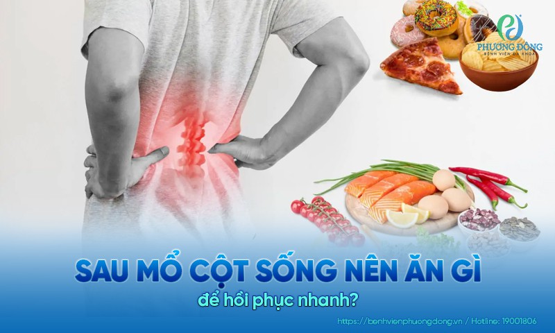 Sau mổ cột sống nên ăn gì và kiêng ăn gì? Nguyên tắc dinh dưỡng