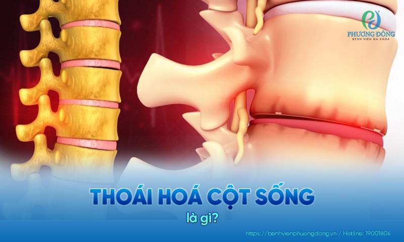 Thoái hóa cột sống: Triệu chứng, nguyên nhân và cách điều trị